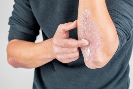 Les bienfaits de la crème au CBD contre le psoriasis