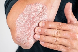 La crème de CBD et le psoriasis les avis